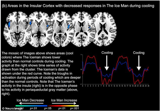 grafische voorstelling van de hersenen van Wim Hof: insula en periductaal grijs gebied -Bron foto: https://lookupdetroit.com/ grafische voorstelling van de hersenen van Wim Hof: insula en periductaal grijs gebied